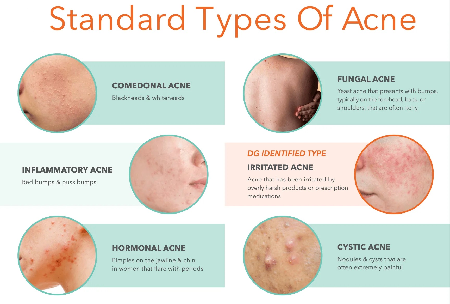 Acne Causes Image 2